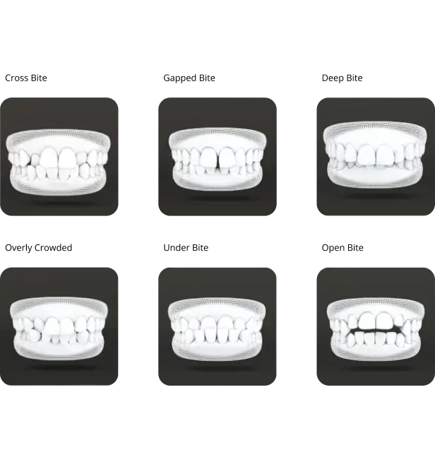 Types of bite issues treatable with clear aligners
