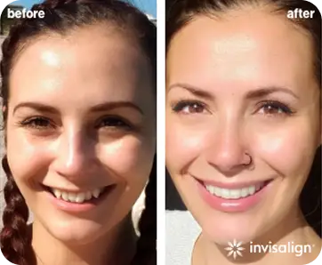 Clear aligner transformation result 1