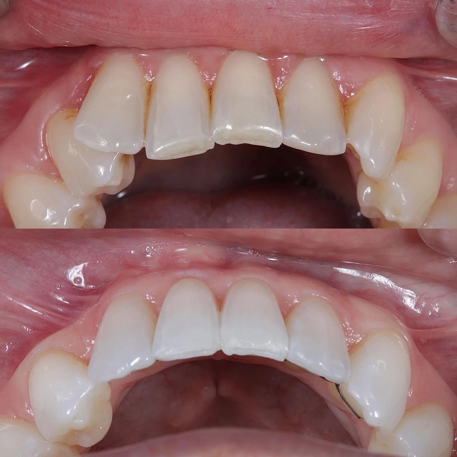 Edge Bonding Restoration - Before and After
