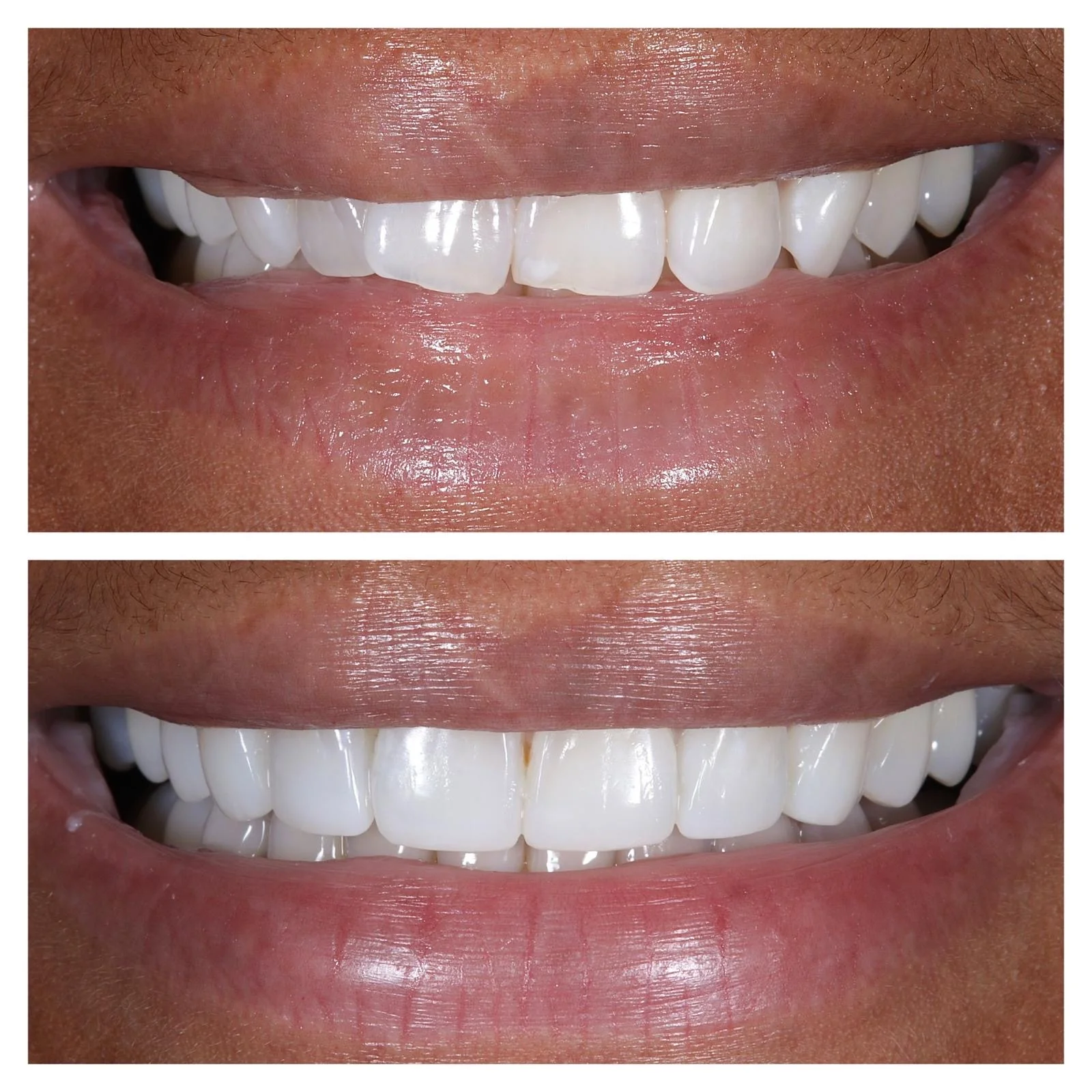 Complete Smile Makeover - Before and After