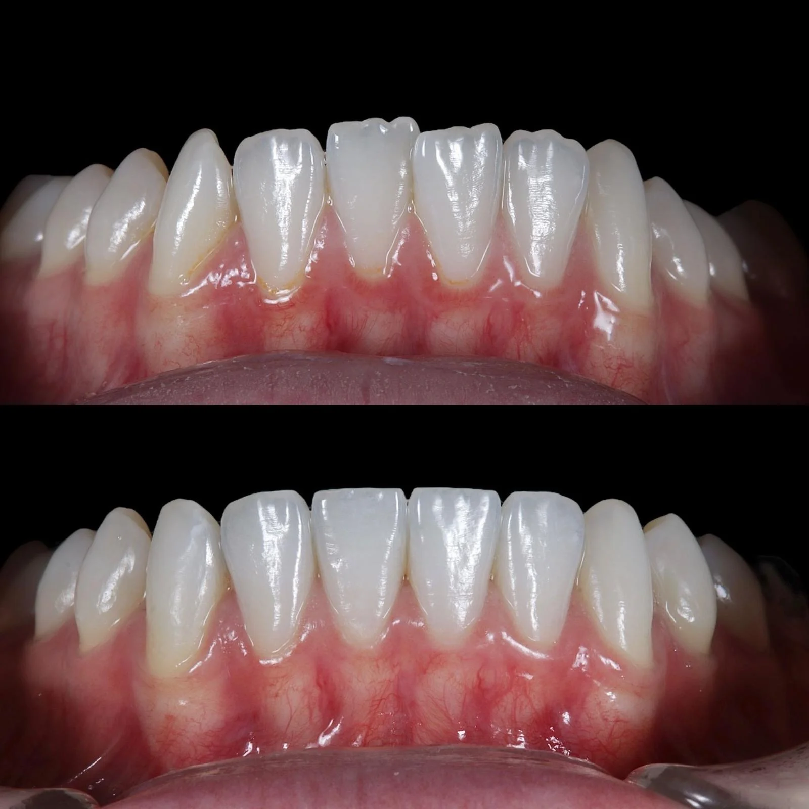 Lower Teeth Alignment - Before and After