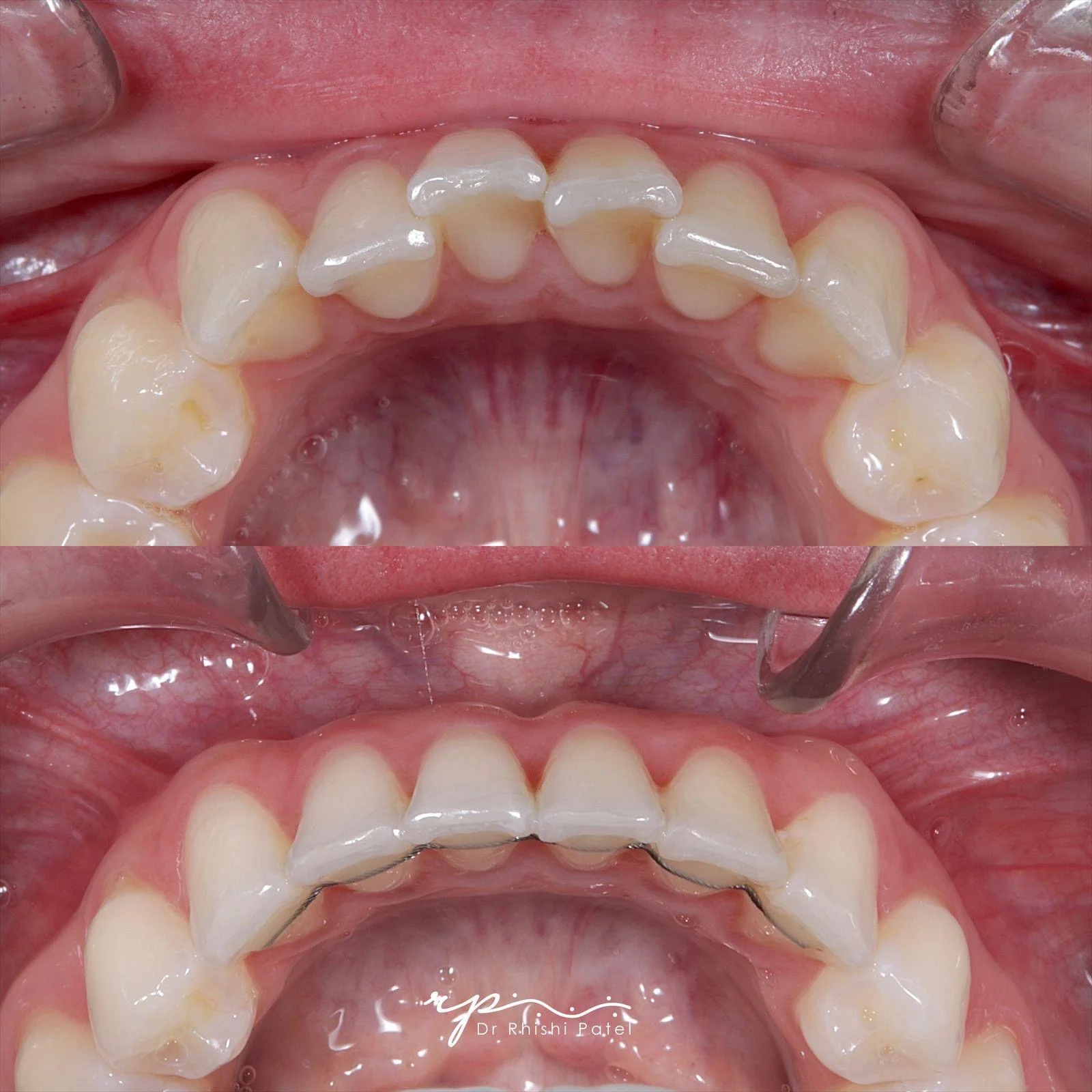 Invisalign for Crowding - Before and After