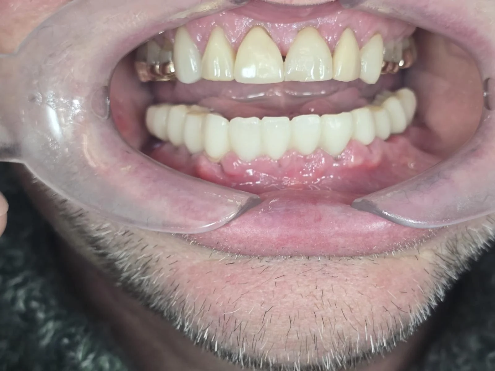 Same-Day Dental Implants & Bridge - After